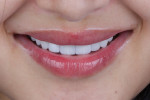 Fig 17. Patient’s smile post-treatment, frontal view with teeth together.