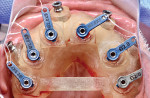 Fig 6. Occlusal view of 3D-printed surgical guide with fixating screws and 2 mm drill sleeves.