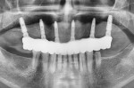 Fig 19. Panoramic x-ray of final full-arch maxillary prosthesis.