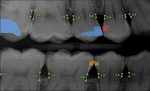 Fig 1. Conventional bitewing radiograph of adult dentition. Fig 1.1. Bitewing radiograph of adult dentition annotated with AI segmented predictions of radiolucent areas within enamel (yellow, teeth Nos. 29 distal and 30 mesial), radiolucent area beyond the dentinoenamel junction (red, tooth No. 5 distal), restorations predicted within the clinical crown of the teeth (blue, teeth Nos. 3 occlusal and 4 mesio-occlusal), and alveolar bone level measurements calculated from cementoenamel junction to proximal crestal bone measured in millimeters (green indicating that the measurement is less than 3 mm). (Images courtesy of Overjet, Inc.)