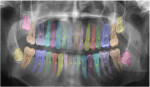 Fig 2. Panoramic radiograph annotated with AI segmentation of adult dentition with universal tooth numbering. (Image courtesy of Overjet, Inc.)