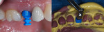 Figure 7  A “snap on” style closed-tray implant impression showing the plastic coping intraorally on the abutment (left) and the analog being inserted into the plastic coping embedded in the impression (right).