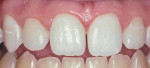 Figure 2  Patients before and after tray bleaching.