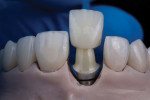 Fig 12. Try-in of final restorations on the model.