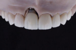Fig 13. Final restorations after polishing and glazing.