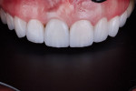 Fig 14. Final restorations after adhesive cementation.