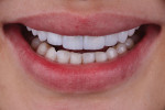 Fig 15. Patient’s smile post-treatment, frontal view.