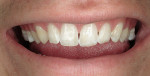 Figure 6  Three days posttreatment; teeth remineralized.