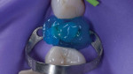 The full-coverage lithium disilicate restoration was tried in to confirm complete seating prior to cementation.