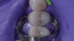 After a clean microbrush was used to remove some of the excess cement from the margins to confirm complete seating, the cement was tack cured on the buccal and palatal aspects for 3 seconds each while maintaining finger pressure, then the remaining excess cement was removed. and the restoration was completely light cured for 20 seconds.