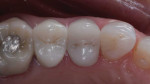 Immediate postoperative occlusal photograph after delivery of the full-coverage porcelain restoration.