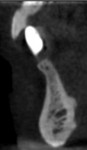 Pretreatment CBCT cross-sectional view of the edentulous tooth No. 24 site demonstrating the narrowness of the ridge buccolingually.