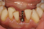 A guide pin was inserted into the osteotomy to verify the depth and orientation in relation to the adjacent teeth and anatomy.