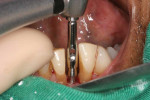 A one-piece implant with a 2.5-mm diameter and 13-mm length was placed using a driver tool on a surgical handpiece and torqued to a value of 40 Ncm.