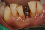 When the placement driver on the handpiece was removed from the mouth, it was noted that the implant’s cervical constriction below the abutment margin was positioned supracrestally, so further insertion was performed with a manual torque wrench until the implant was at the proper depth.