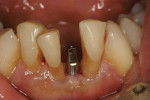 View of the implant after it was fully seated in the site so that the cervical constriction below the abutment margin was sitting 1-mm apical to the gingival level.