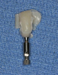 Extraoral view of the provisional crown after it was removed from the stent and placed on an implant analog and the gingival contour was developed using flowable resin to establish a proper emergence profile.