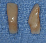 Facial and proximal views, respectively, of the immediate provisional restoration following staining and glazing, demonstrating contours that mimic the patient’s natural teeth.