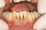 Retracted view of the immediately placed provisional restoration on the implant at the surgical appointment.
