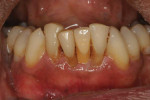 Immediate posttreatment view of the final implant-supported PFM crown. Note how the staining helps it to blend with the adjacent teeth.