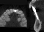 An immediate posttreatment CBCT scan demonstrating how the narrow diameter implant fits within the confines of the available bone at the site.