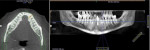 Coronal and panoramic views of a CBCT scan acquired 3 years after implant placement and permanent restoration demonstrating maintenance of the bone with no observable changes since placement.