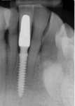 Periapical radiograph acquired 10 years after implant placement and restoration demonstrating maintenance of the crestal bone levels.