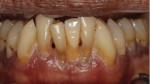 Close-up photograph acquired 10 years after implant placement and restoration demonstrating the clinical appearance of the restoration and adjacent natural teeth, which was still esthetically acceptable to the patient because his lip line hid the cervical area. Note the slight further recession and further darkening of the exposed roots of the natural teeth.