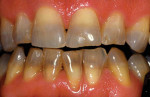 Before photograph of a tetracycline stain whitening case treated using the KöR Whitening ULTRA-T whitening kits and protocol, which are specifically intended for the most difficult cases, such as those involving tetracycline staining and dentinogenesis imperfecta.