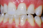 After photograph of a tetracycline stain whitening case treated using the KöR Whitening ULTRA-T whitening kits and protocol, which are specifically intended for the most difficult cases, such as those involving tetracycline staining and dentinogenesis imperfecta.