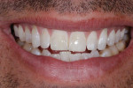 Pretreatment frontal smile photograph displaying an anterior open bite, right-side posterior edge-to-edge bite, and left-side posterior crossbite.