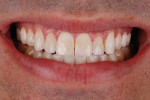 Smile photograph acquired after the completion of clear aligner therapy, which resulted in dental expansion of the maxilla to correct the posterior edge-to-edge occlusion and crossbite.