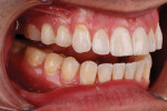 Right lateral retracted photograph with the teeth apart displaying the better alignment of the teeth after clear aligner therapy. Note the severe posterior wear.