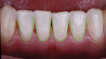 Closeup view of the mandibular anterior teeth after the initial depth cuts and spatial dimensions were established for the final porcelain restorations. Due to the open gingival embrasures and the desire to practice responsible esthetics, the elbow preparation technique was utilized to maintain tooth structure and close off the proximal areas apical to the contacts.