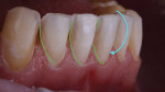 In the right lateral view, the margins are now tucked away interproximally, improving the esthetics and closing off the gingival embrasure areas. The final restorations will now have a rotational path of draw.