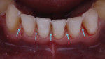 From an occlusal view, the preparation margins can be readily seen on the incisal aspects of the teeth, but then they disappear apical to the proximal contacts.