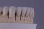 In a right lateral view of the model, it can be seen that the ceramist masterfully created beautiful restorations with the margins completely tucked into the interproximal areas.