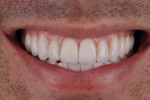 Final posttreatment smile photograph revealing the patient with a broader arch form as a result of the clear aligner therapy utilized prior to preparation to correct the posterior crossbite.