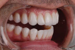 Right lateral retracted view of the final lithium disilicate restorations (IPS e.max® Lithium Disilicate, Ivoclar) with the teeth apart. The final restorations restored proper cuspal form to achieve a functionally stable occlusion.