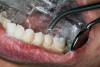 Figure 8  The screw-retained provisional restoration with ovate pontics (with particulate allograft material in sockets).
