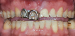 Fig 1. Initial retracted view. The patient’s chief concern was significant wear on the incisal edges of the anterior teeth adjacent to tooth No. 8.