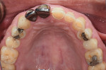 Fig 2. Initial maxillary occlusal view showing dentin exposure and severe erosion.
