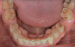Fig 3. Initial mandibular occlusal view showing dentin exposure and erosion.