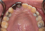 Fig 7. Maxillary transitional composite restorations.