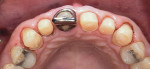 Fig 8. Crown preparations prior to extraction of tooth No. 8.