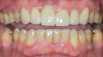 Fig 10. Layered zirconia restorations on Nos. 6 through 11 and mandibular composite restorations.