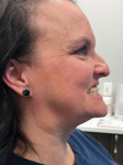 Patient profile portrait photograph at her initial appointment. She was in the last tray of her clear aligner treatment plan, which had corrected the severe protrusion and crowding in her maxillary arch, but desired restorations to restore her severe attrition and further correct the protrusion. Porcelain crowns were recommended for teeth Nos. 5 through 12.