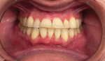 Close-up retracted view of the patient at her crown preparation appointment. Note the severe attrition of teeth Nos. 5 through 12, abfraction lesions on teeth Nos. 6 and 11, and overjet.