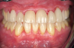 Posttreatment retracted view of the final porcelain-fused-to-zirconia crowns on teeth Nos. 5 through 12.