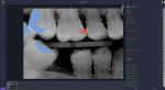 Overjet’s Clinical Intelligence Platform is the only AI solution that is FDA-cleared for both decay detection and bone level quantification.